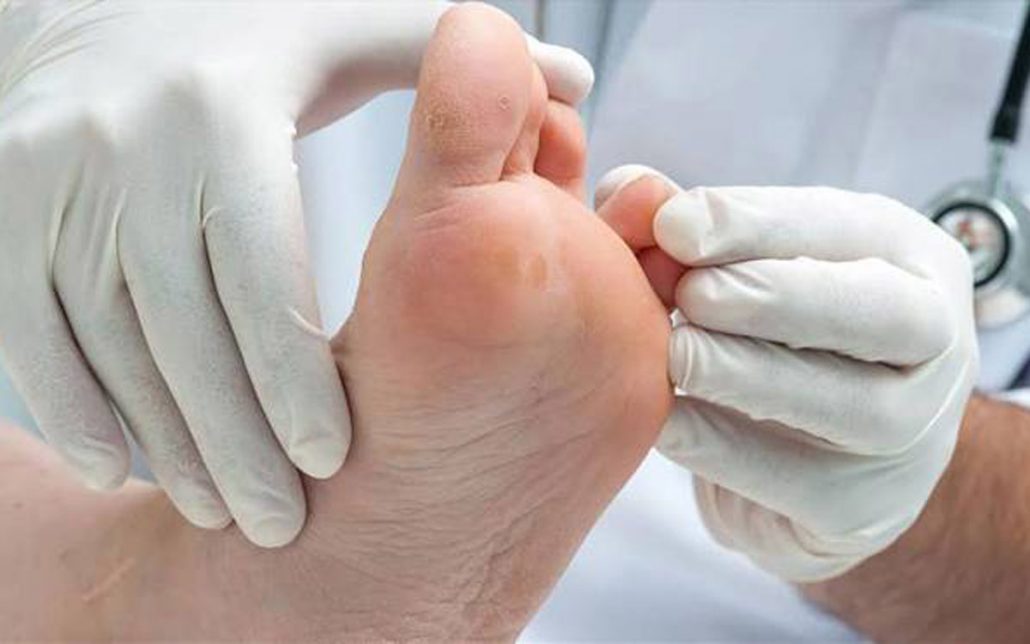 زخم پای دیابتی